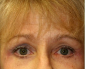Feel Beautiful - Blepharoplasty Under Browlift 101 - After Photo